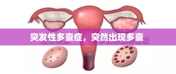 突发性多囊症,突然出现多囊