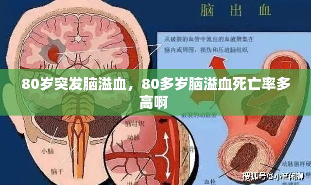 80岁突发脑溢血,80多岁脑溢血死亡率多高啊